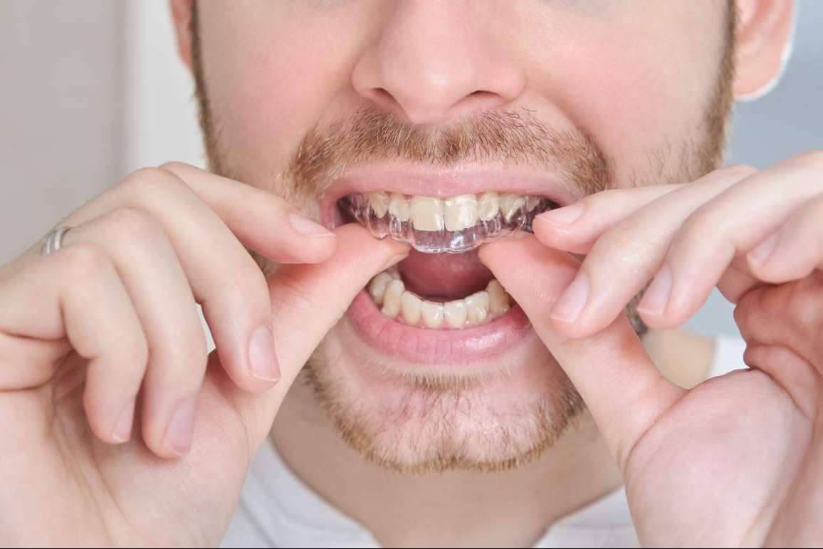 Beneficios de la ortodoncia invisible, por Clínicas Dental Bell