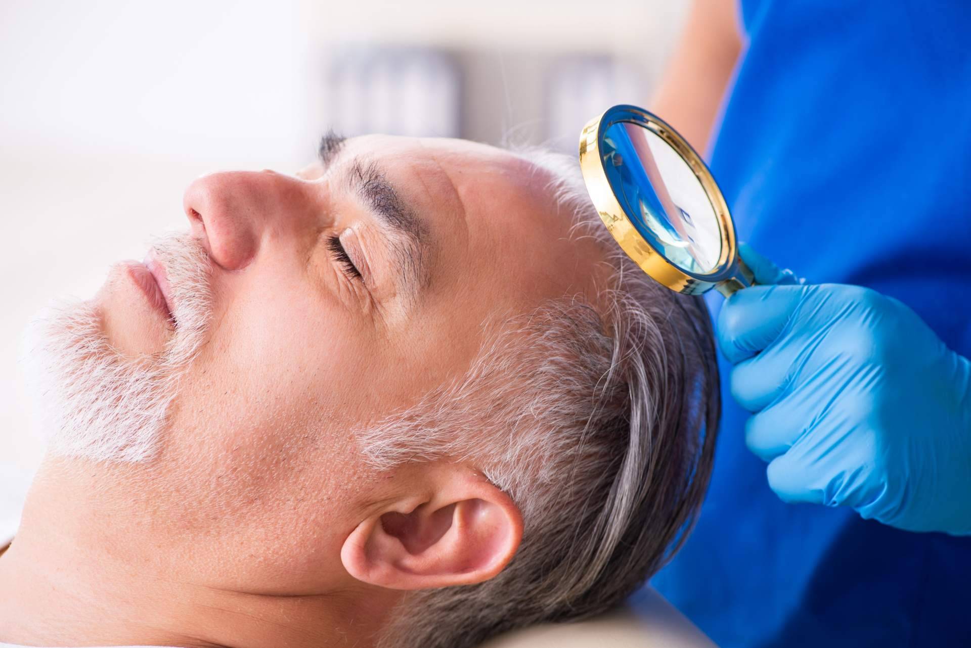 Implantes capilares con Clínicas Élite Capilar, destacados expertos en el sector