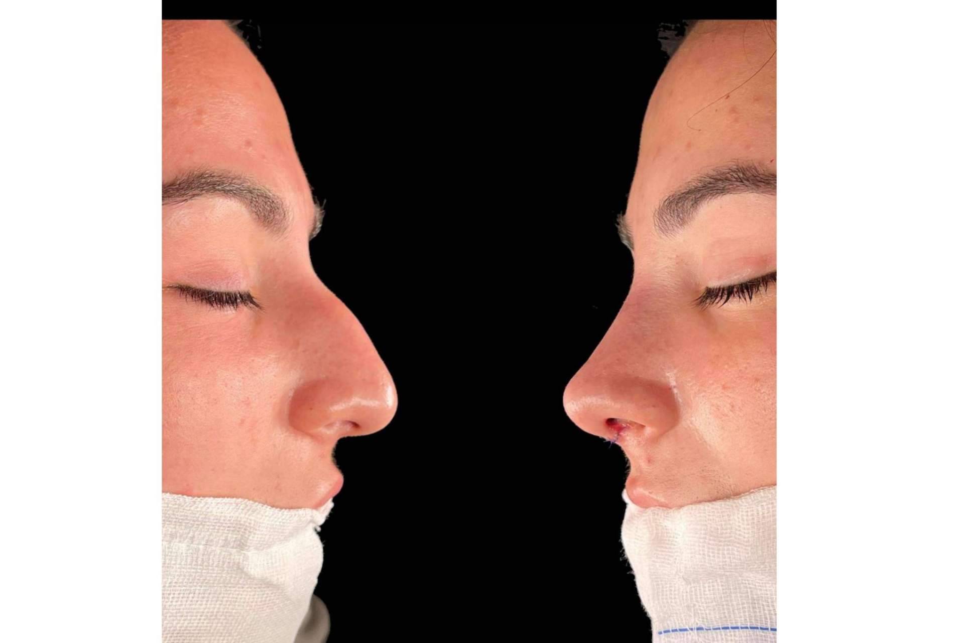 De qué manera recuperarse de una rinoplastia, de la mano del Dr. Pérez Villar