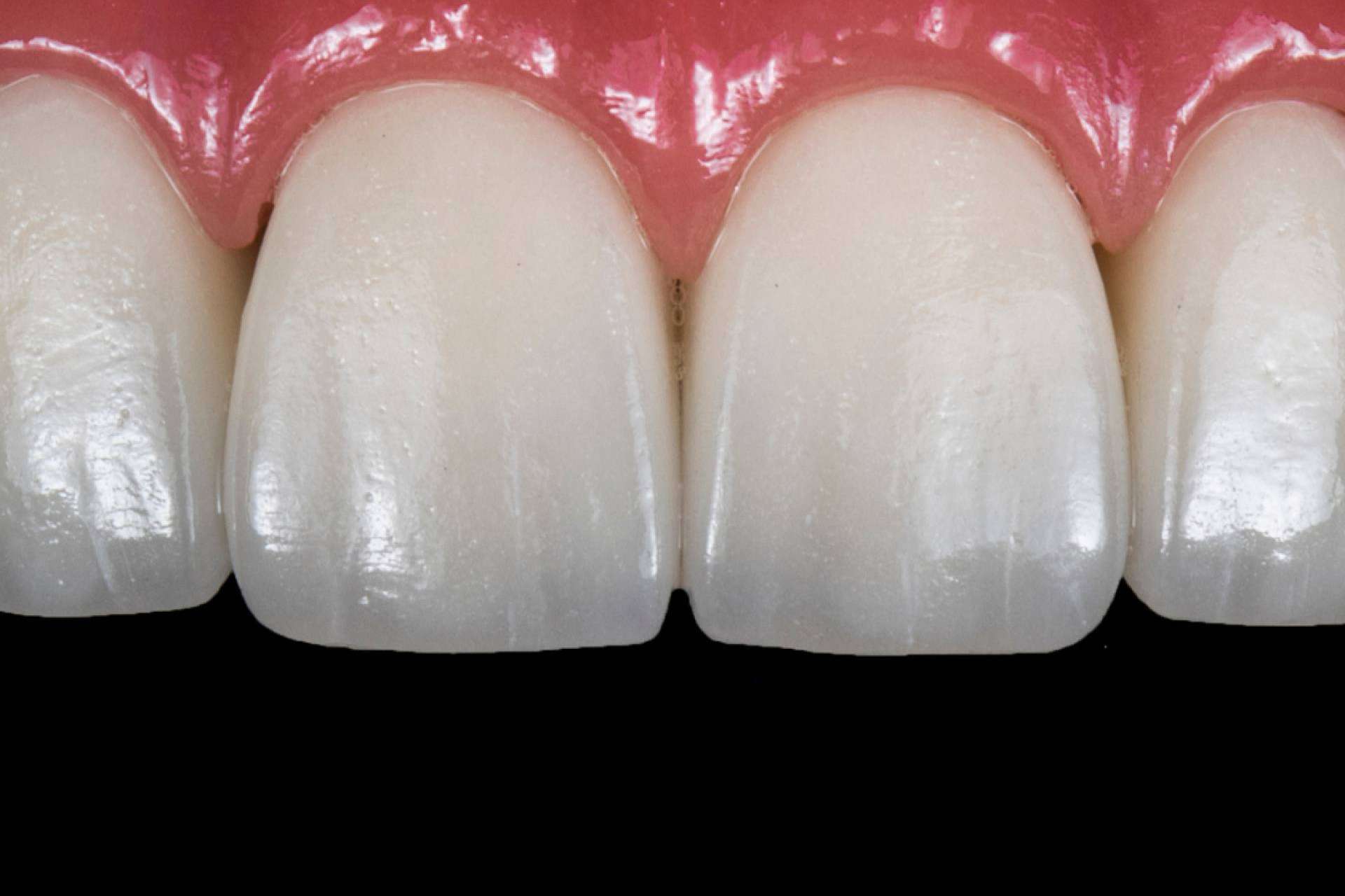 Corporación Dental realiza implantes de carga inmediata en Antequera