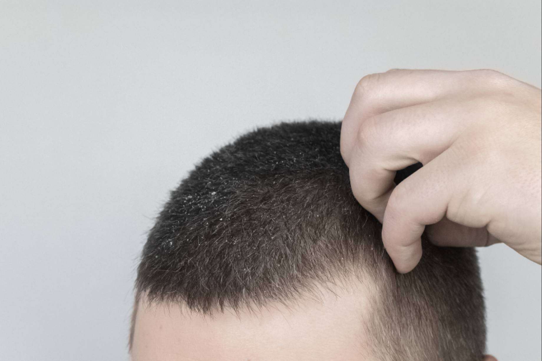 La caspa podría ser culpable de la caída del cabello