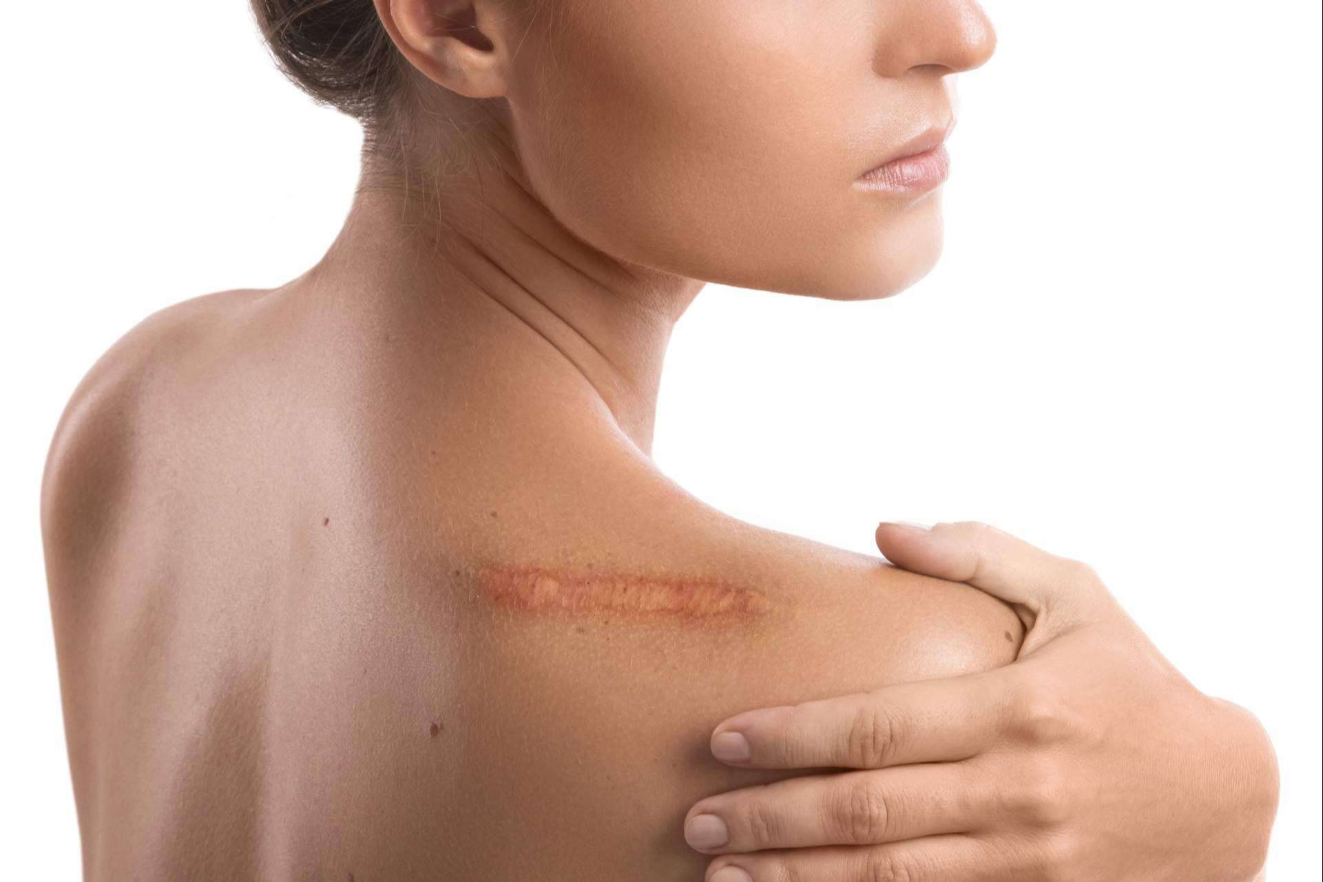 Los expertos de La Parafarmacia del Puerto explican cómo cuidar las cicatrices en la piel de cara al verano