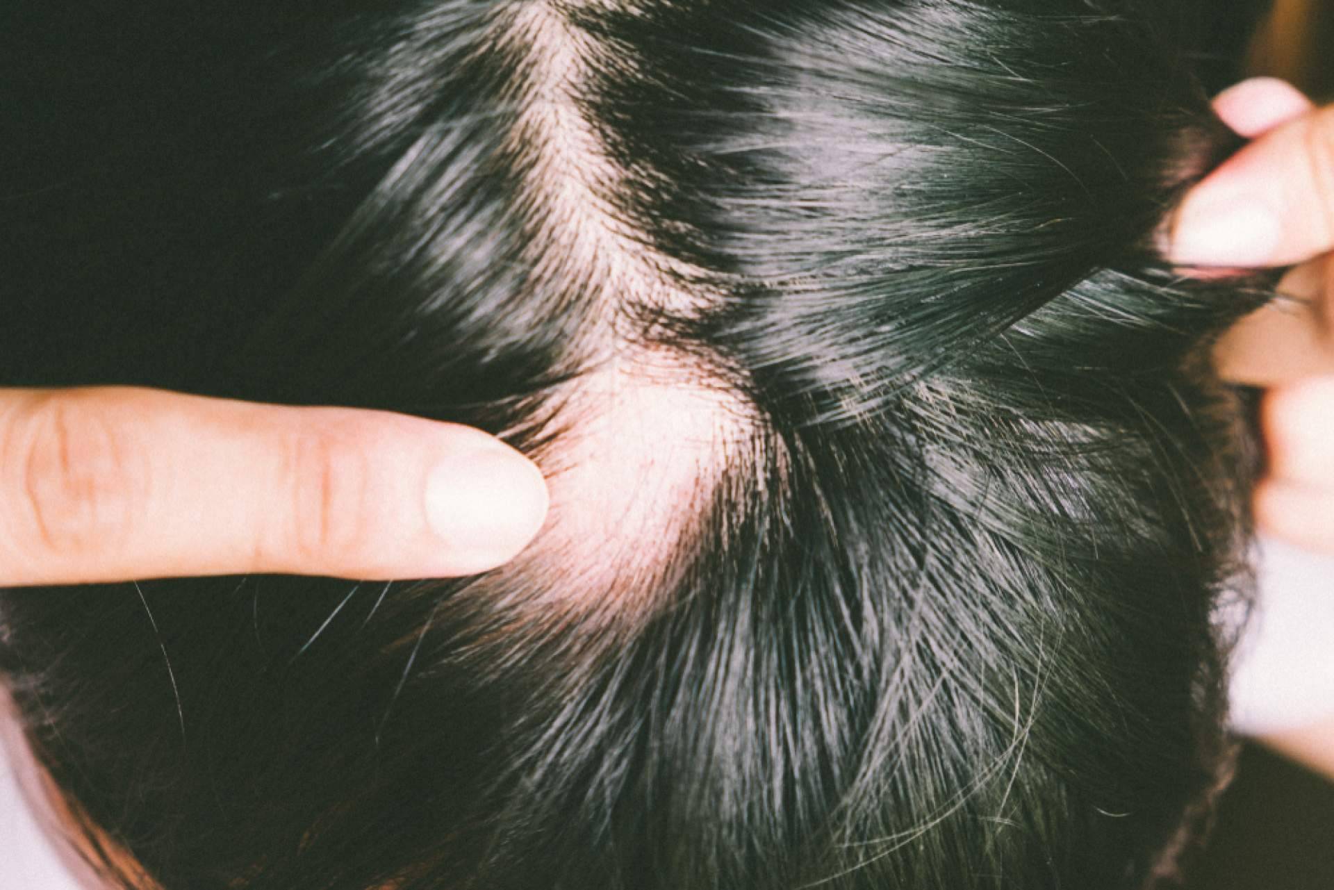 ¿Qué es la alopecia areata y cómo disimularla?