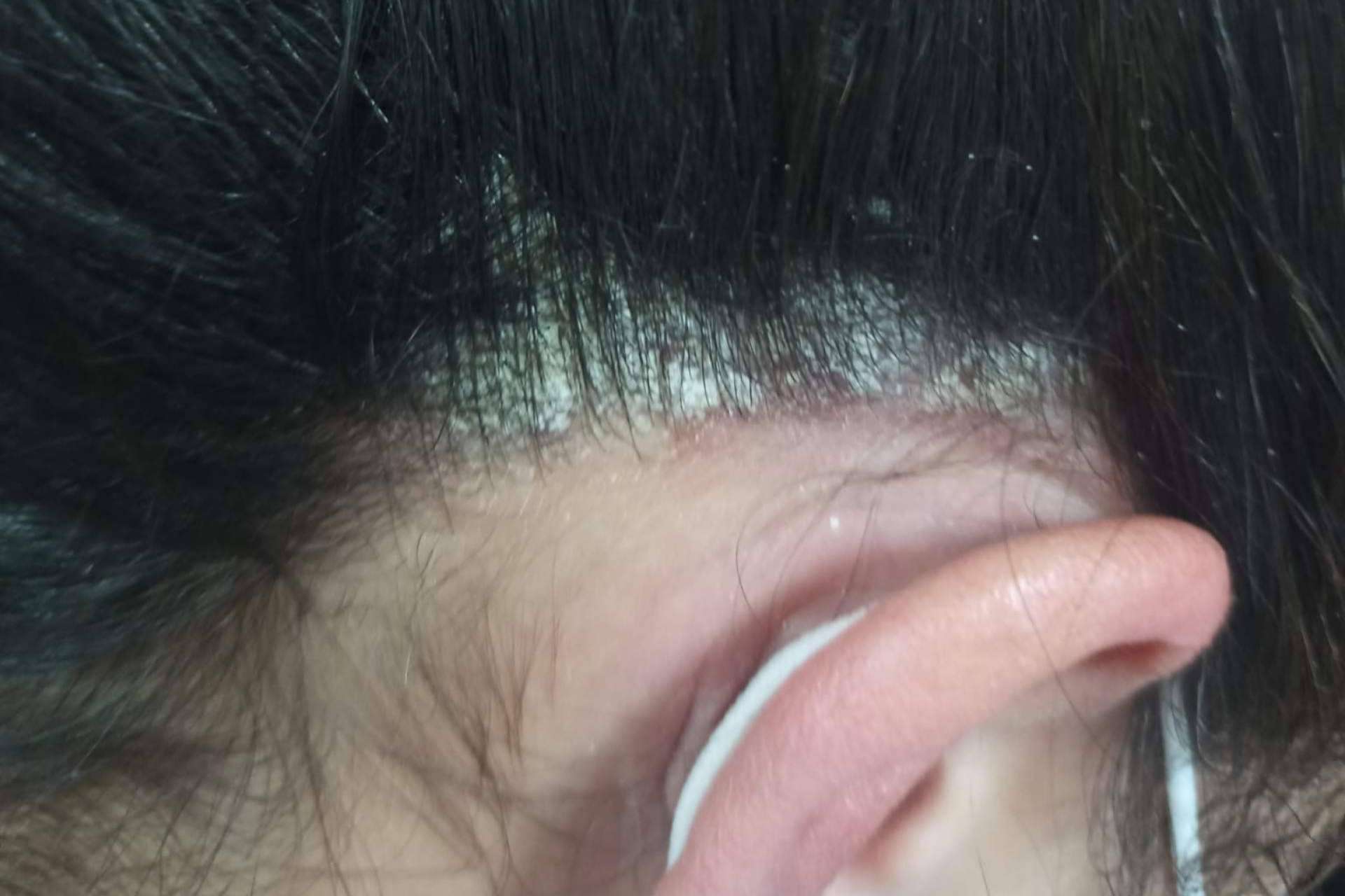 Acupuntura y fototerapia, tratamientos para los problemas de la piel con Nüwa
