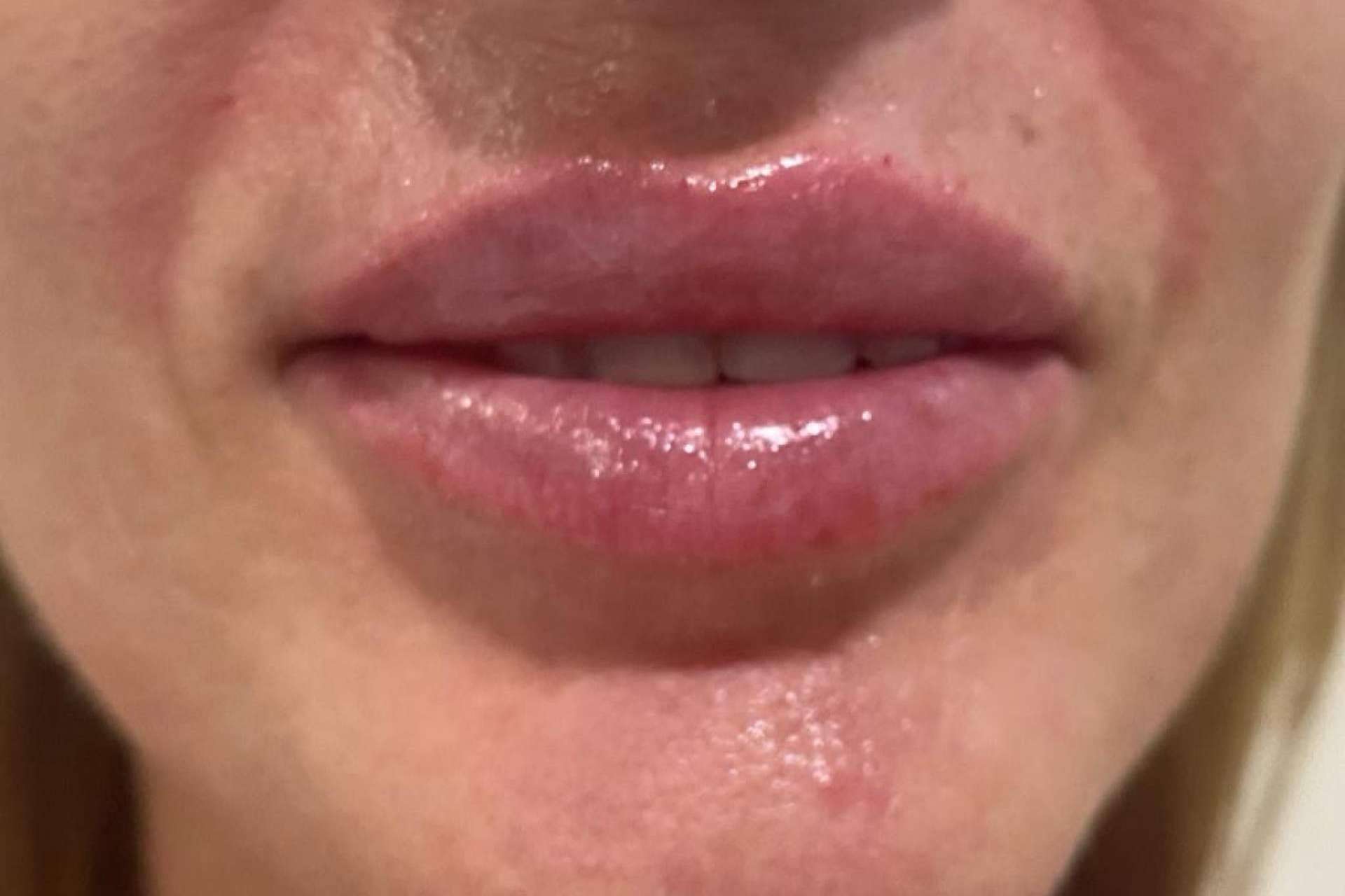 Remodelación y aumento de labios con rellenos de ácido hialurónico