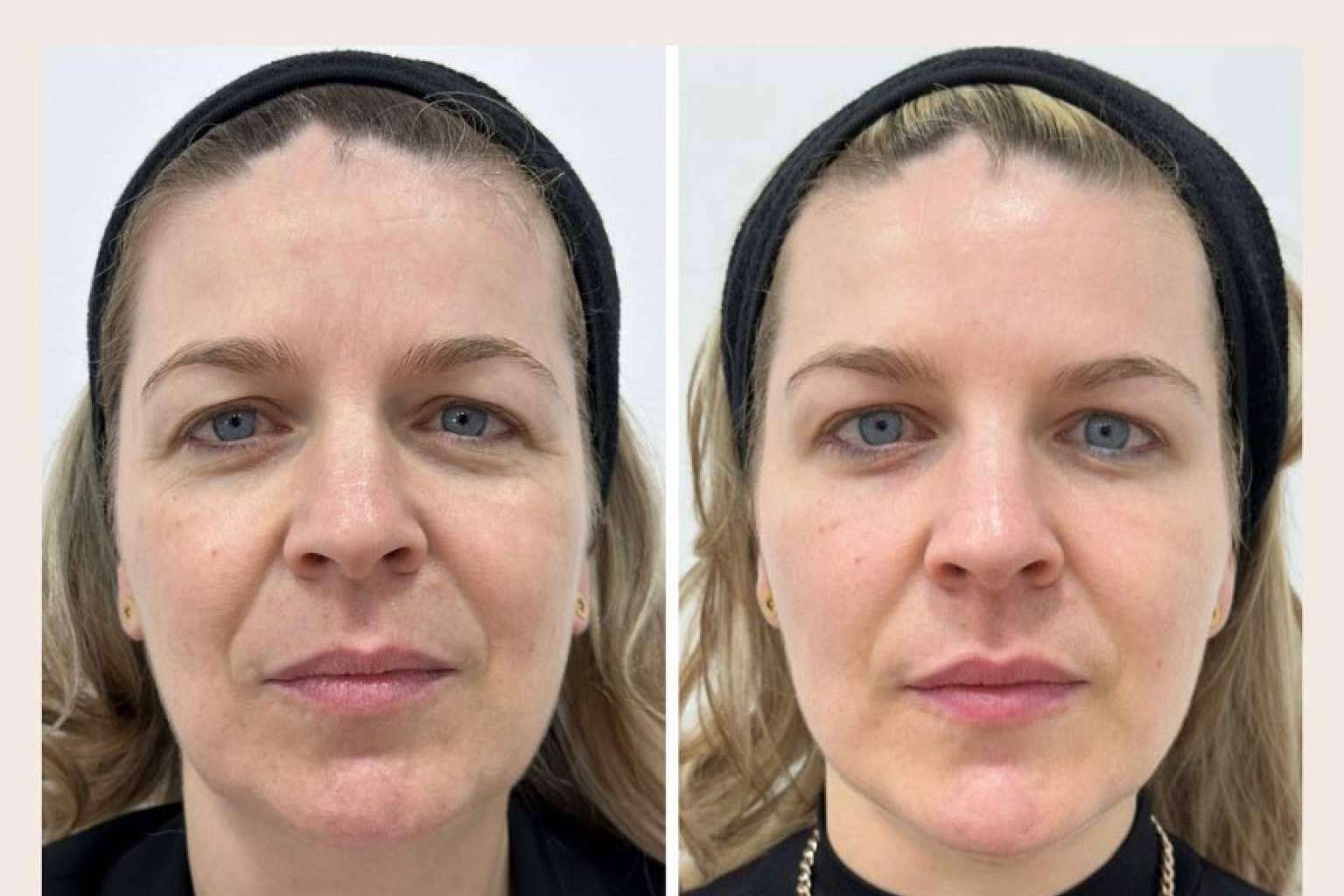 Clínica VISO sobre cómo combatir la flacidez facial