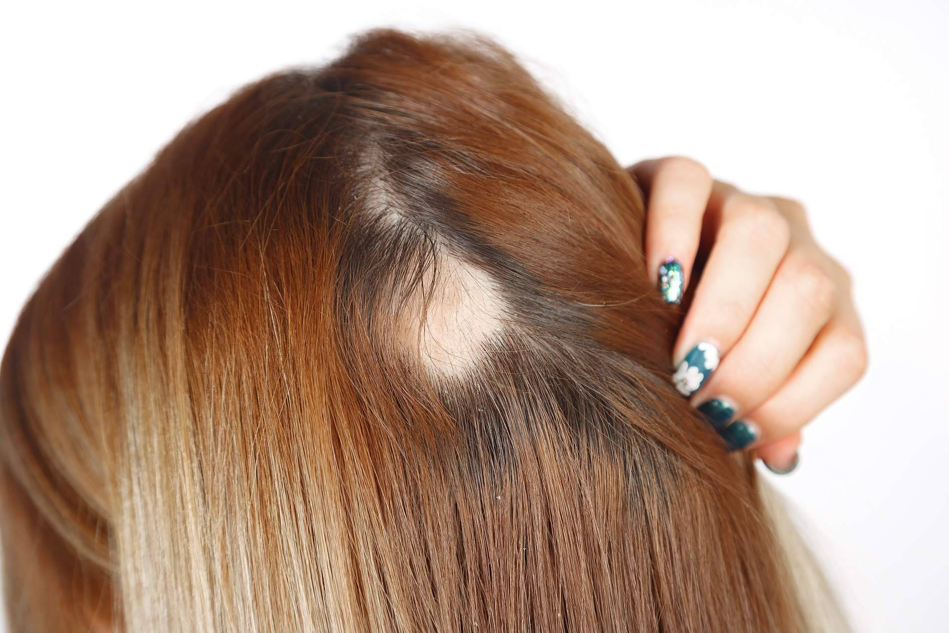 Cómo combatir la alopecia femenina, el método de Capilar Innovation Clinic