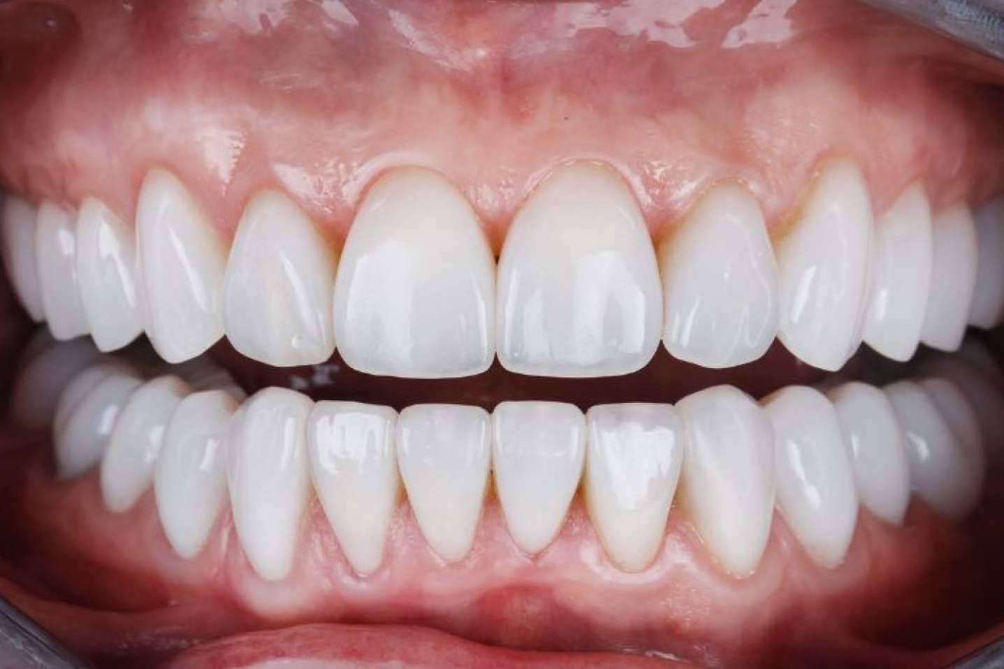 Los beneficios de las carillas de composite, por Clínica Dental Ruiz de Gopegui