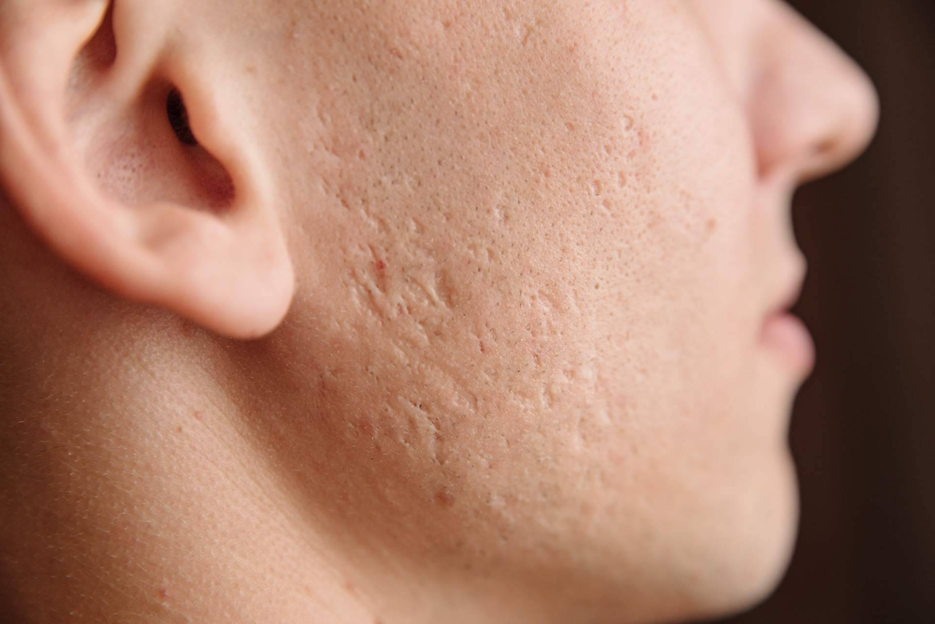Alluring Clinic, tratamiento de cicatrices de acné con radiofrecuencia fraccionada con microagujas