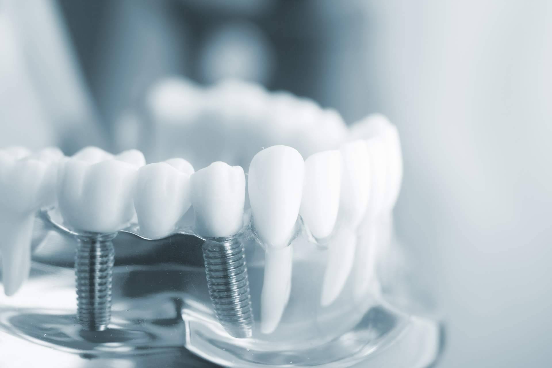 DeltaDent expone las principales ventajas de los implantes de Zirconio
