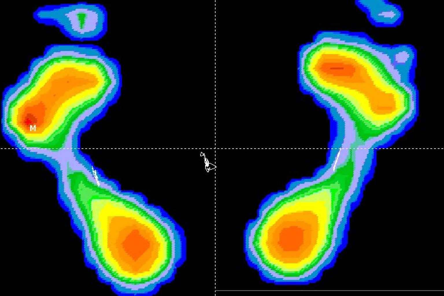 Clínica Podológica M.O. recalca la importancia de un estudio biomecánico en el deporte