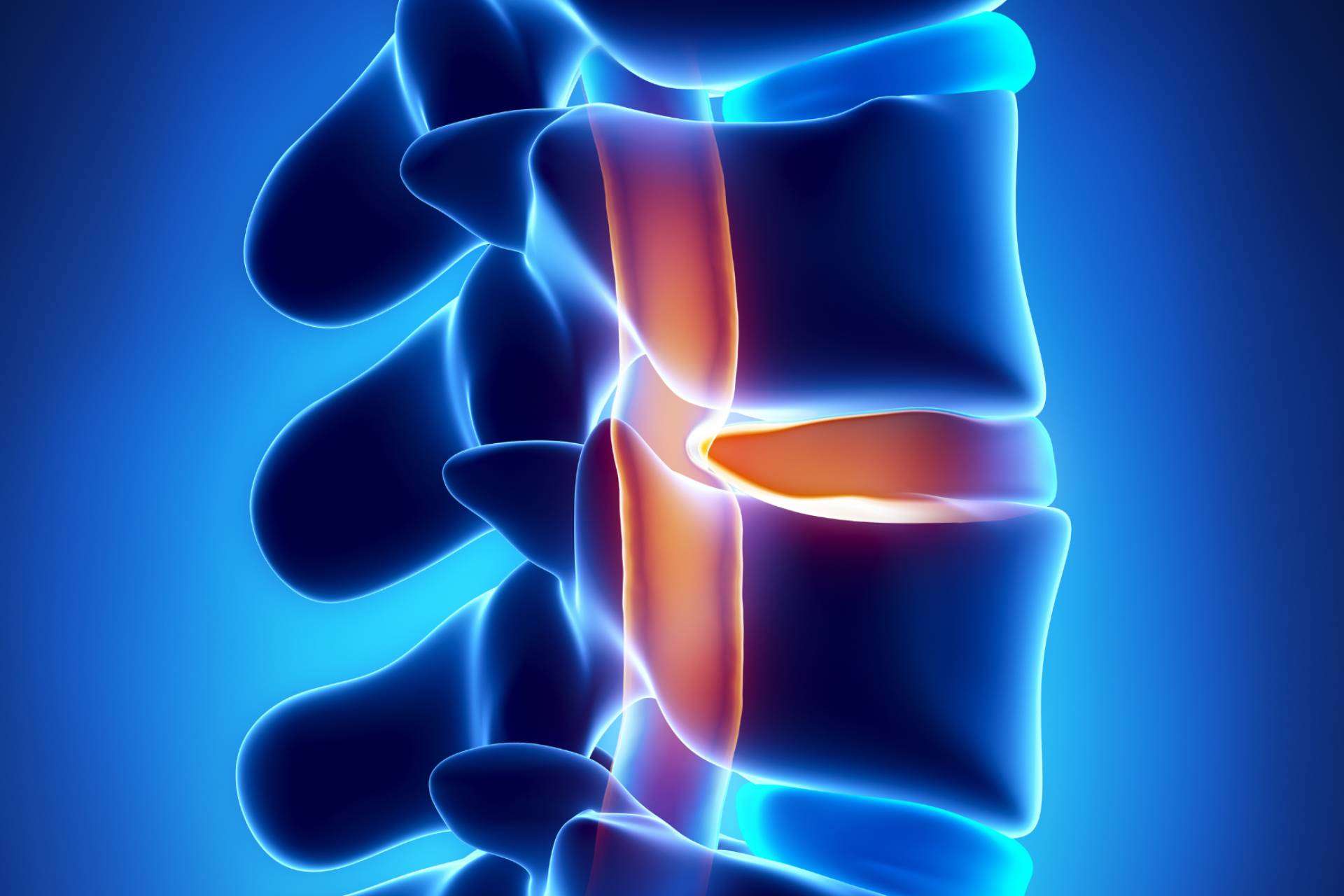 Hernia discal y andulación, un enfoque terapéutico innovador
