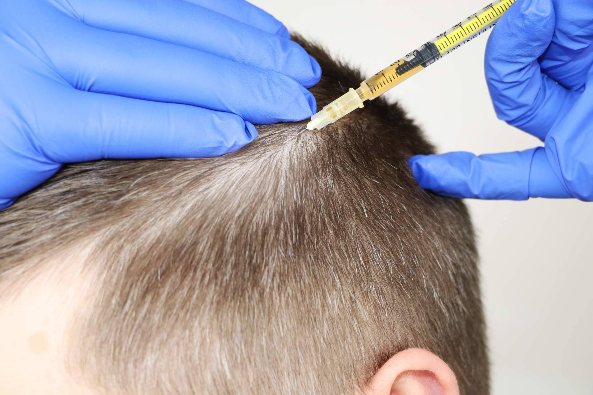 Los tratamientos de mesoterapia son una alternativa muy recomendada para las personas que sufren alopecia según el doctor Jesus Mora