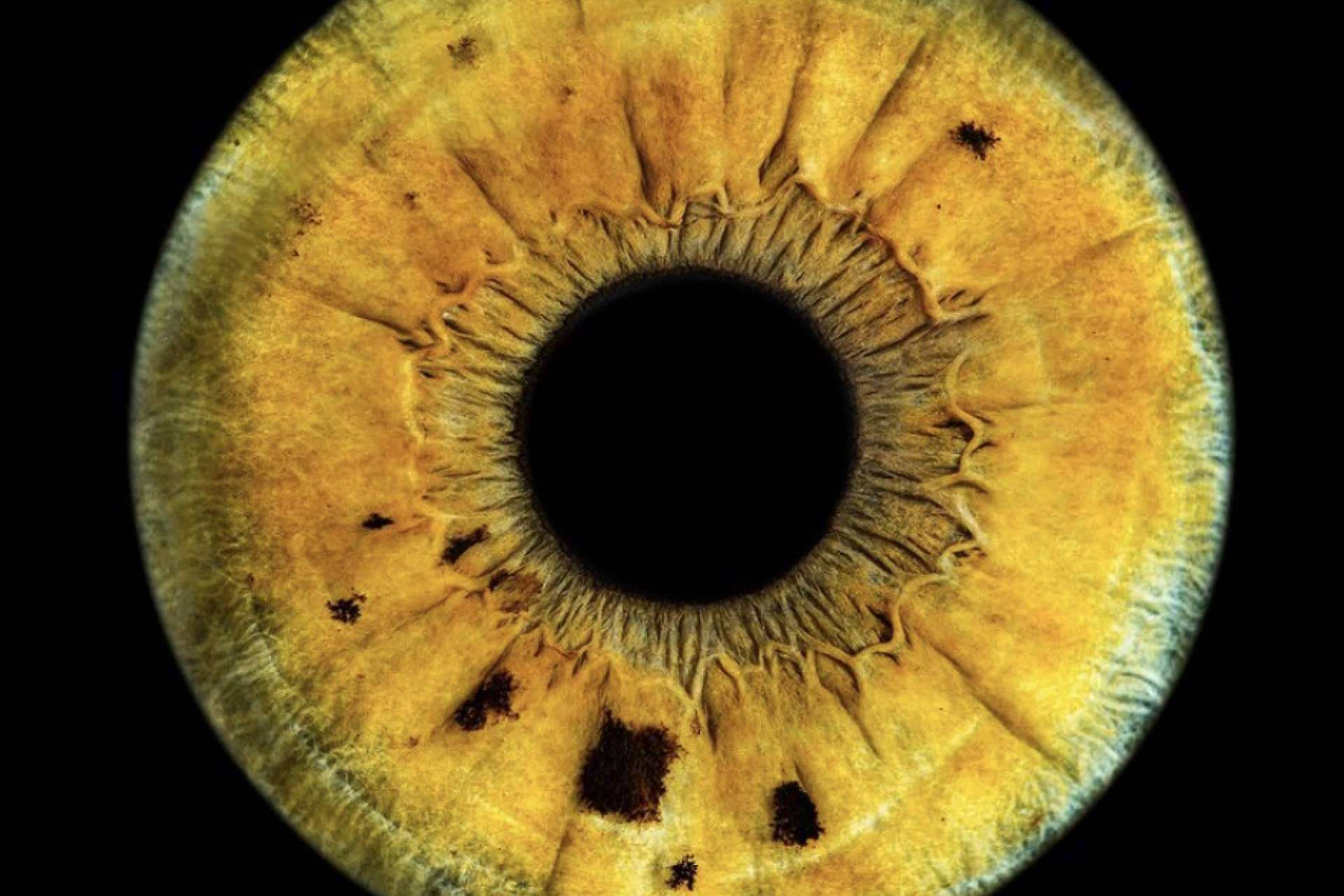 Cómo es el perfil psicológico sano de los pacientes que realizan láser de cambio de color de ojos