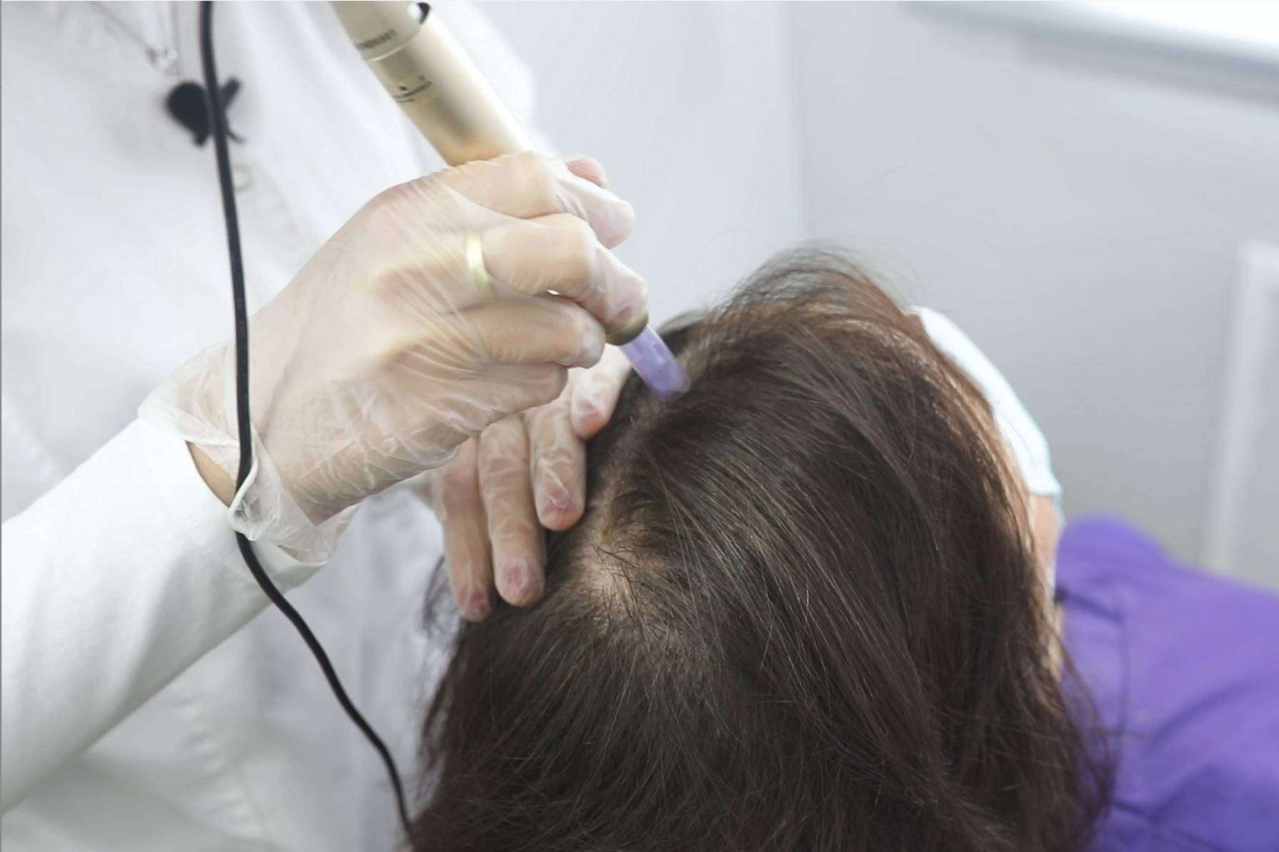 Los más de 20 años poniendo solución a la alopecia areata de IMD