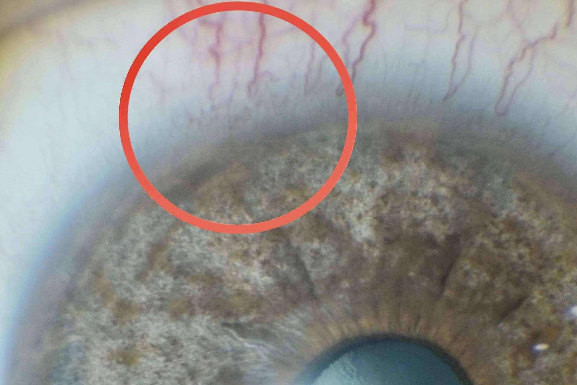 Cómo funciona el tratamiento láser de las manchas pigmentarias de la conjuntiva
