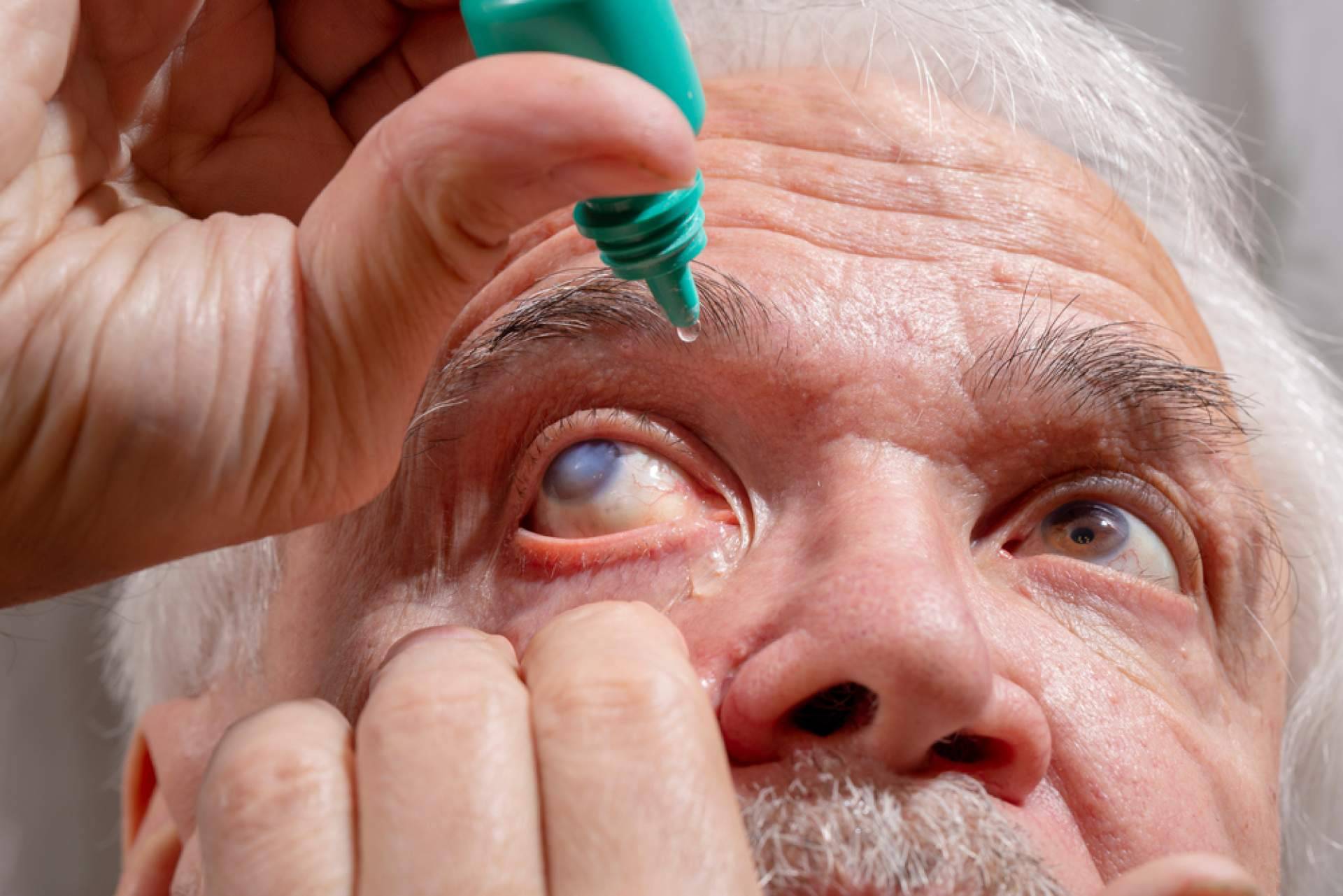 Departamento de Oftalmología del Hospital Universitario Dexeus explica cuáles son los síntomas y tratamientos del glaucoma