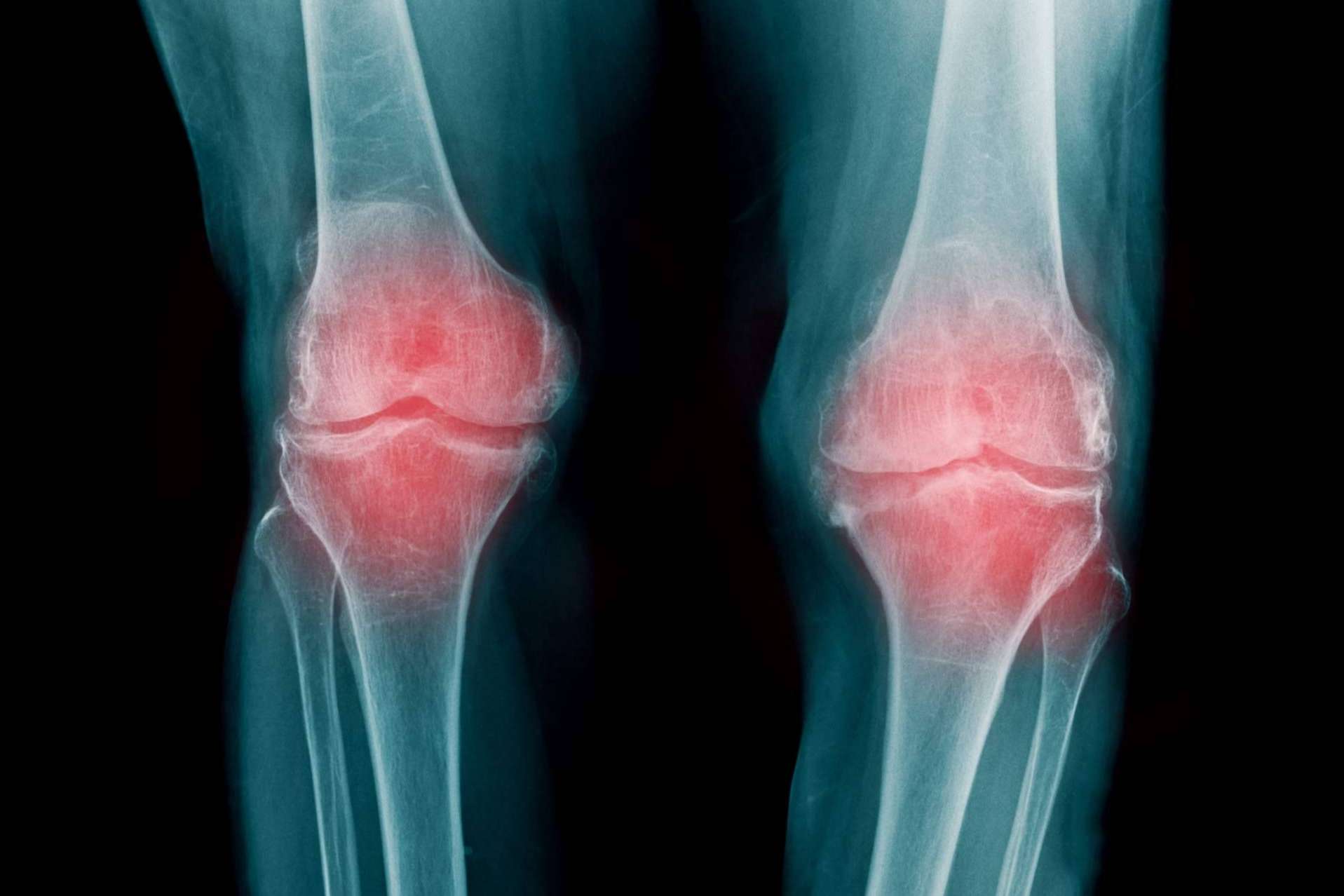iXalud colabora con la asociación de pacientes de artrosis y osteoporosis OAFI