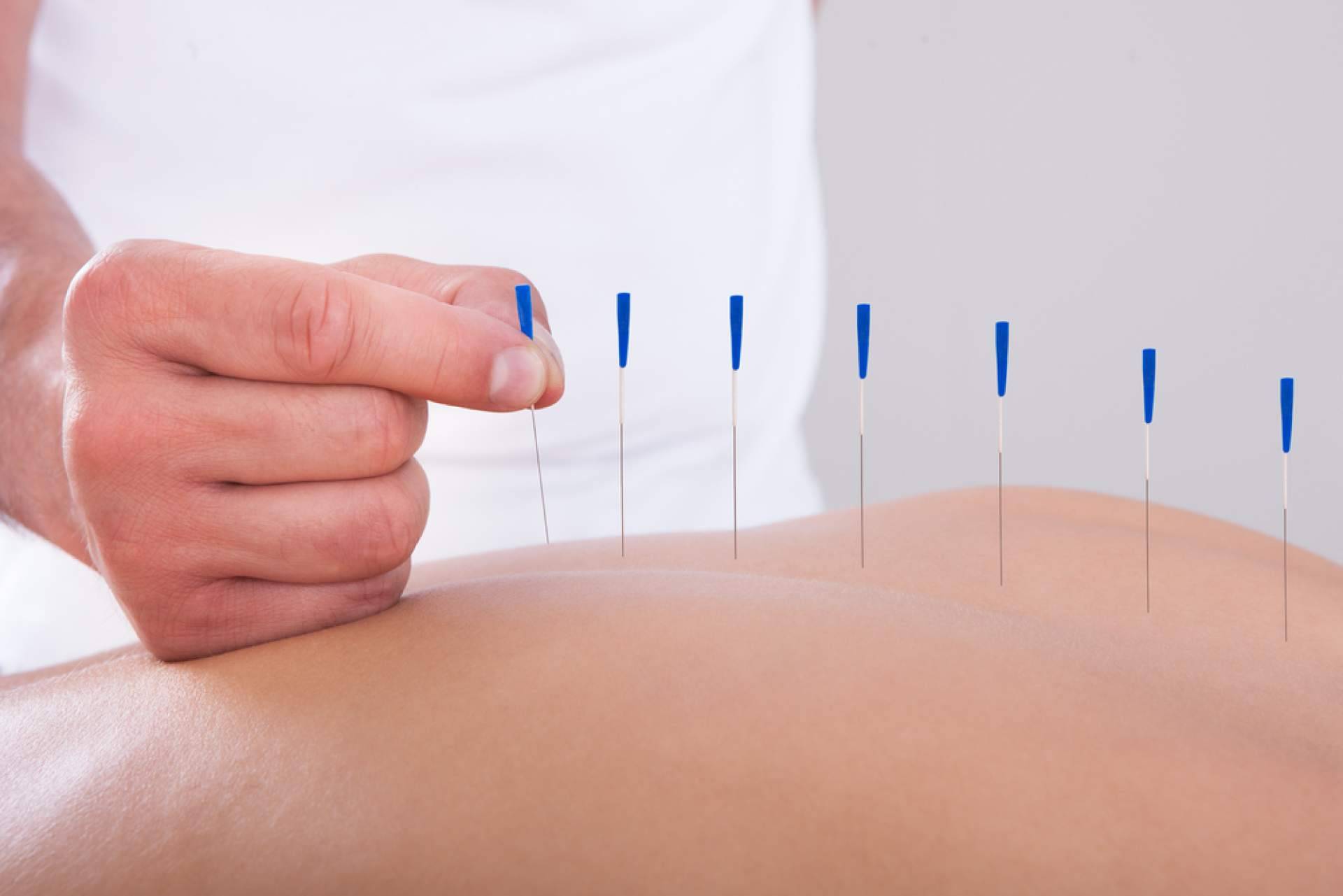 Los múltiples beneficios para la salud que aporta la acupuntura, por Shenti Wellness