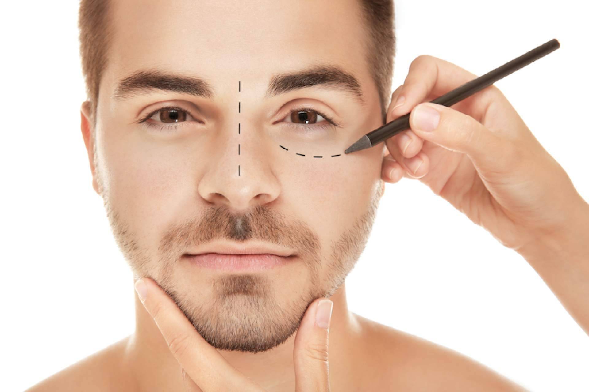 Blefaroplastia no quirúrgica ayuda a tratar párpados superiores e inferiores cuando existe piel redundante