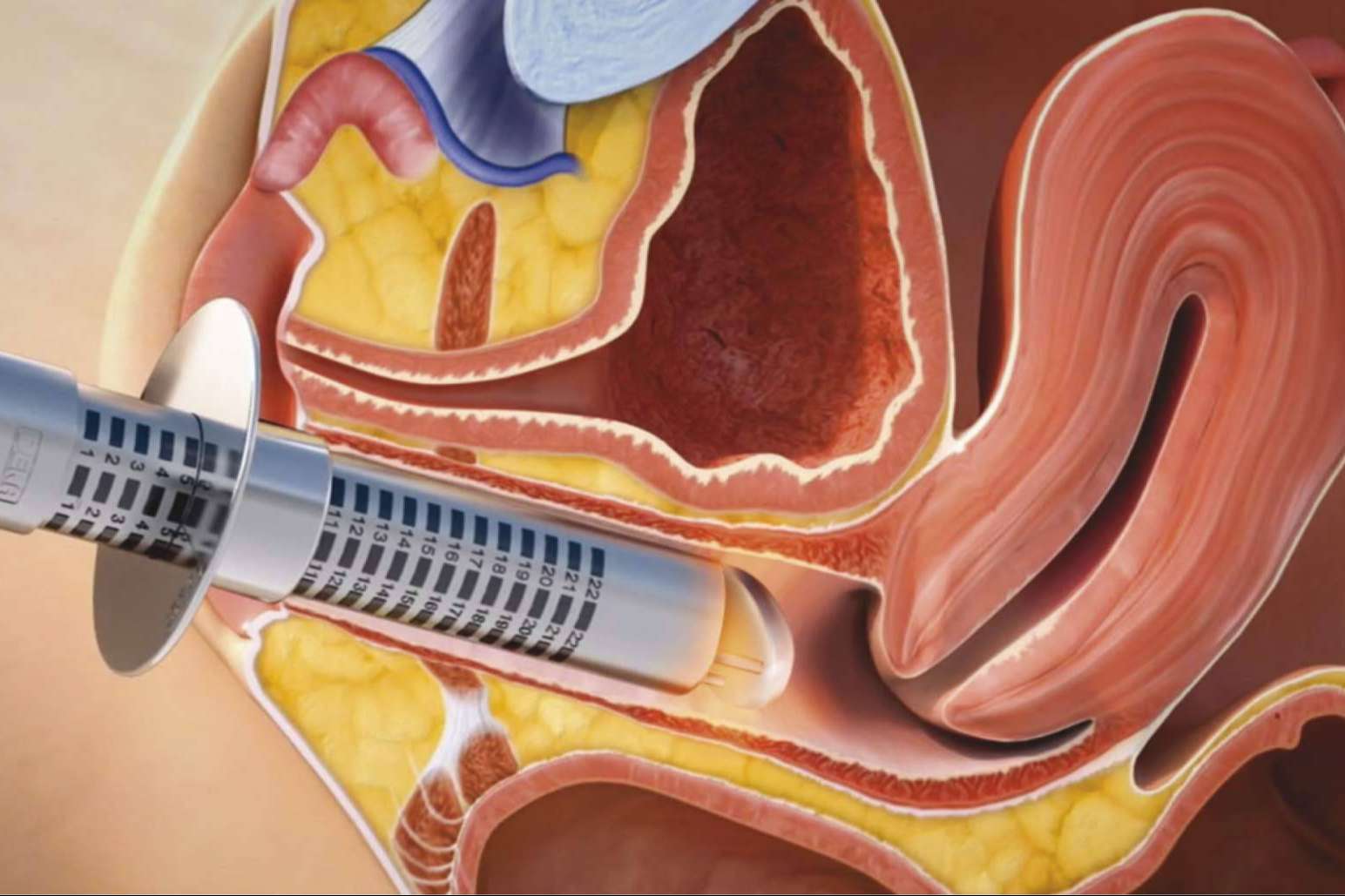 Las secuelas del cáncer de mama… de las que nadie habla