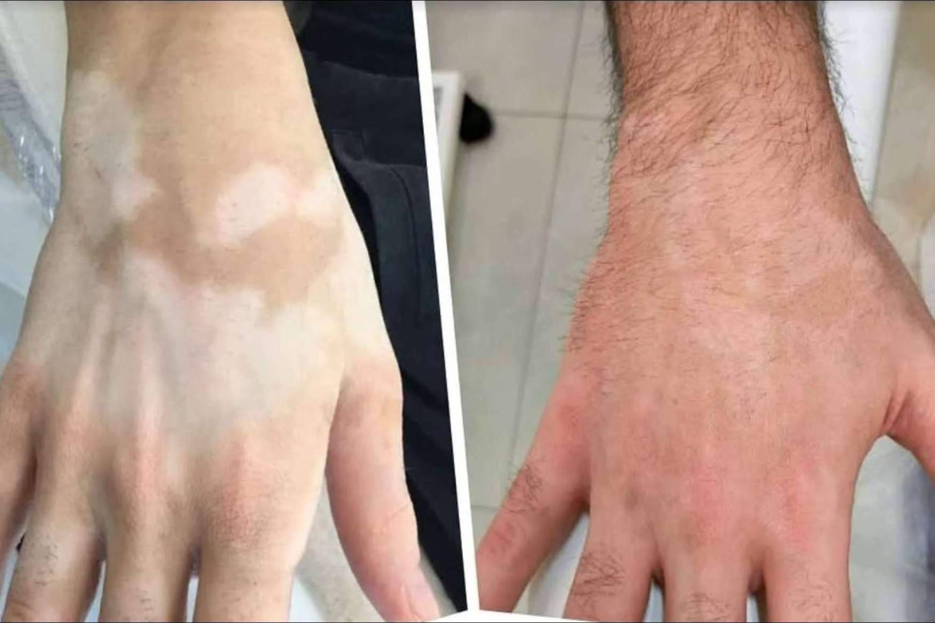 TERAV tratamiento estético de repigmentación artificial para vitiligo en Dermopigmentación Clínica