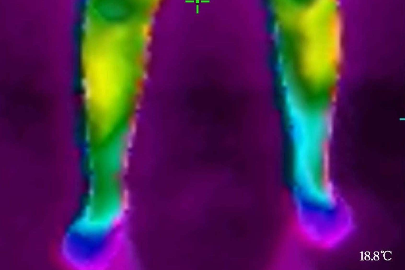 Es posible saber cuál es el tipo de celulitis con la cámara termográfica