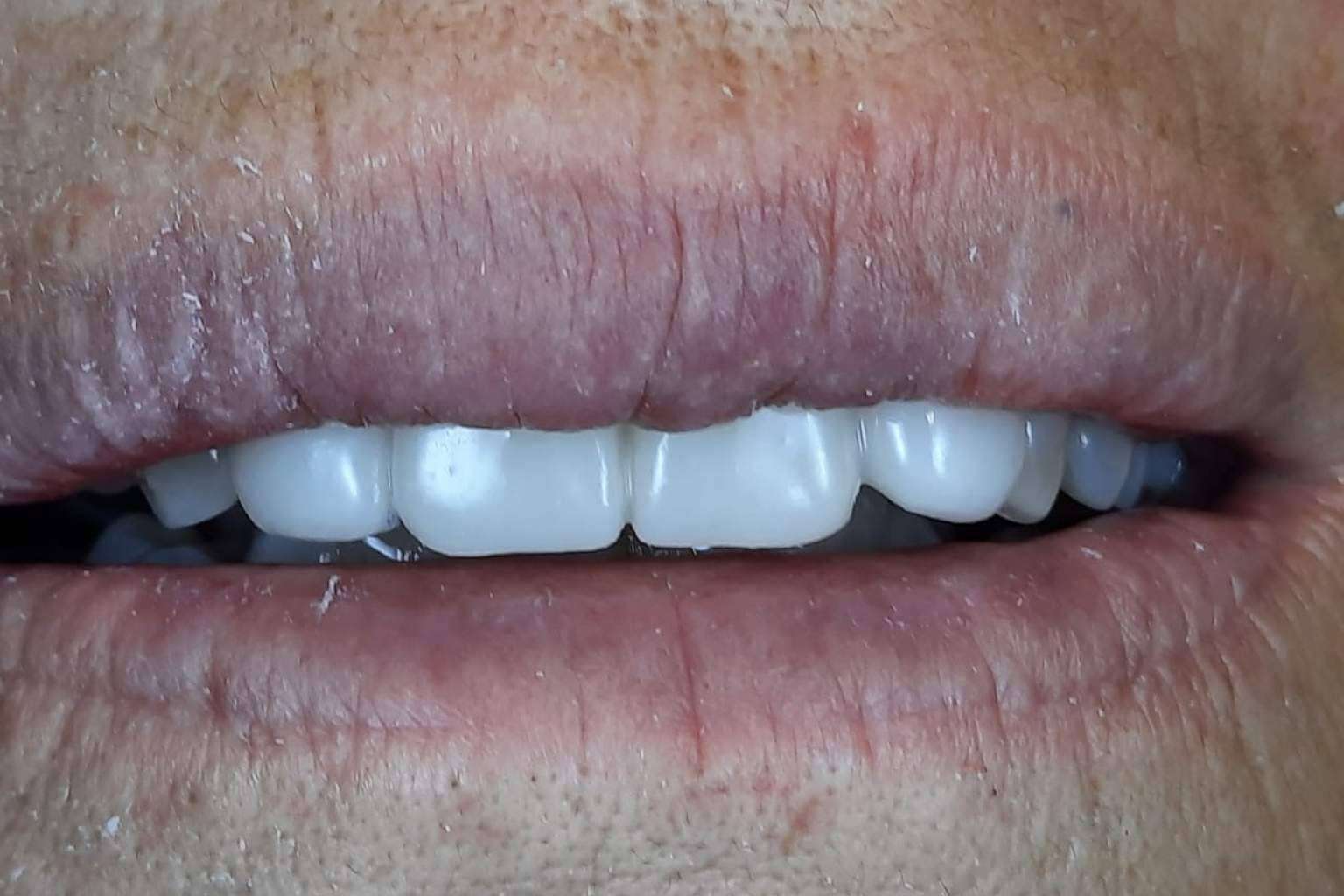 ¿Dónde encontrar especialistas en recuperar la sonrisa y la salud bucodental con implantes dentales cerámicos? Clínica Biorigenera