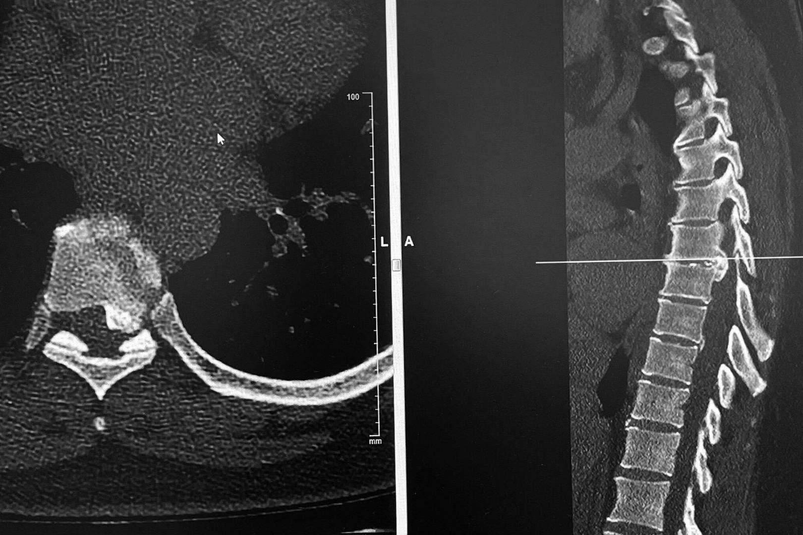 Cirugía de hernia discal con el neurocirujano especialista Dr. Carlos Botella-Asunción