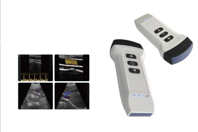 Ecógrafo de mano inalámbrico; Innovación en diagnóstico médico