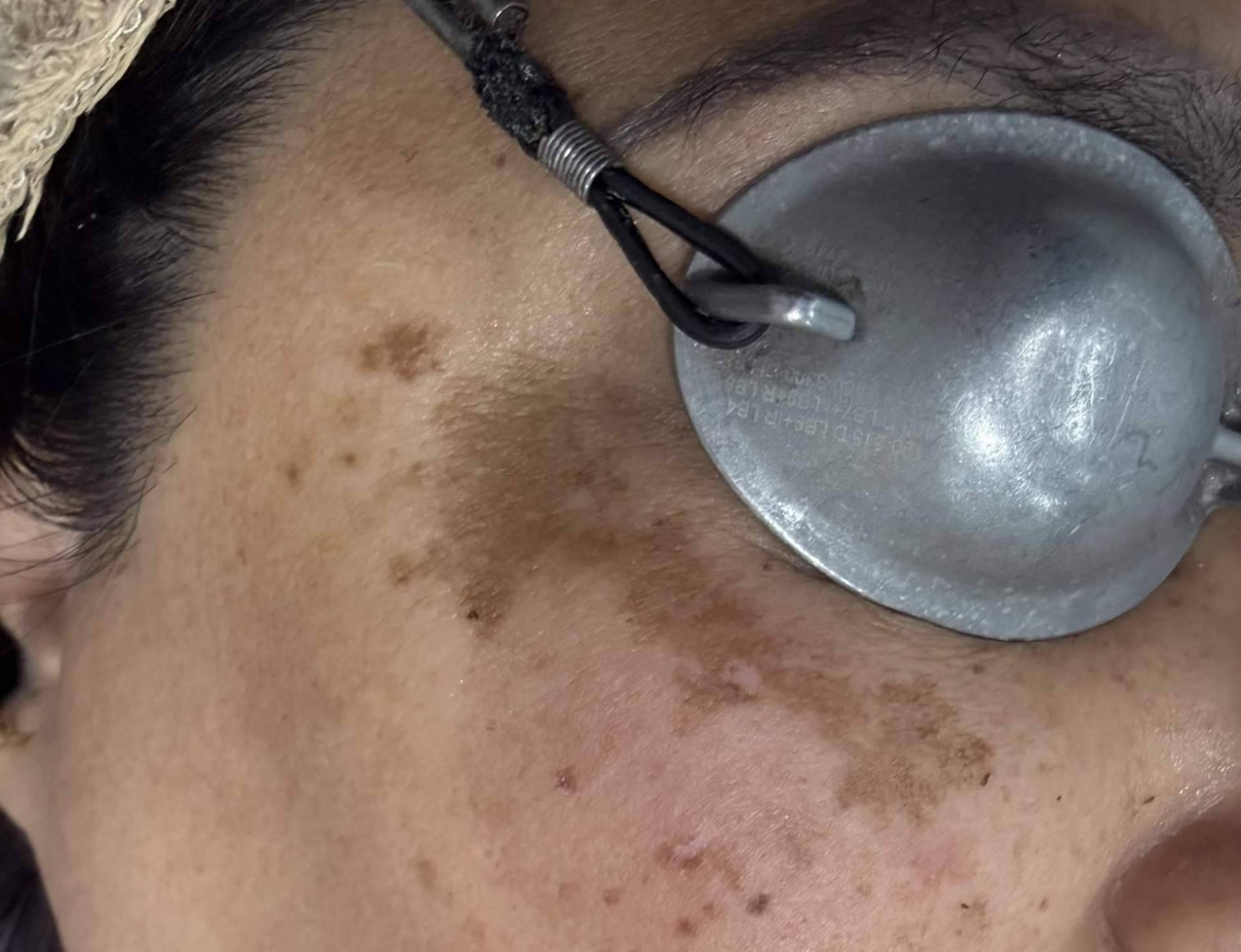 La Dra. Janeth Arévalo analiza los factores que agravan el melasma y los alimentos que influyen en su evolución