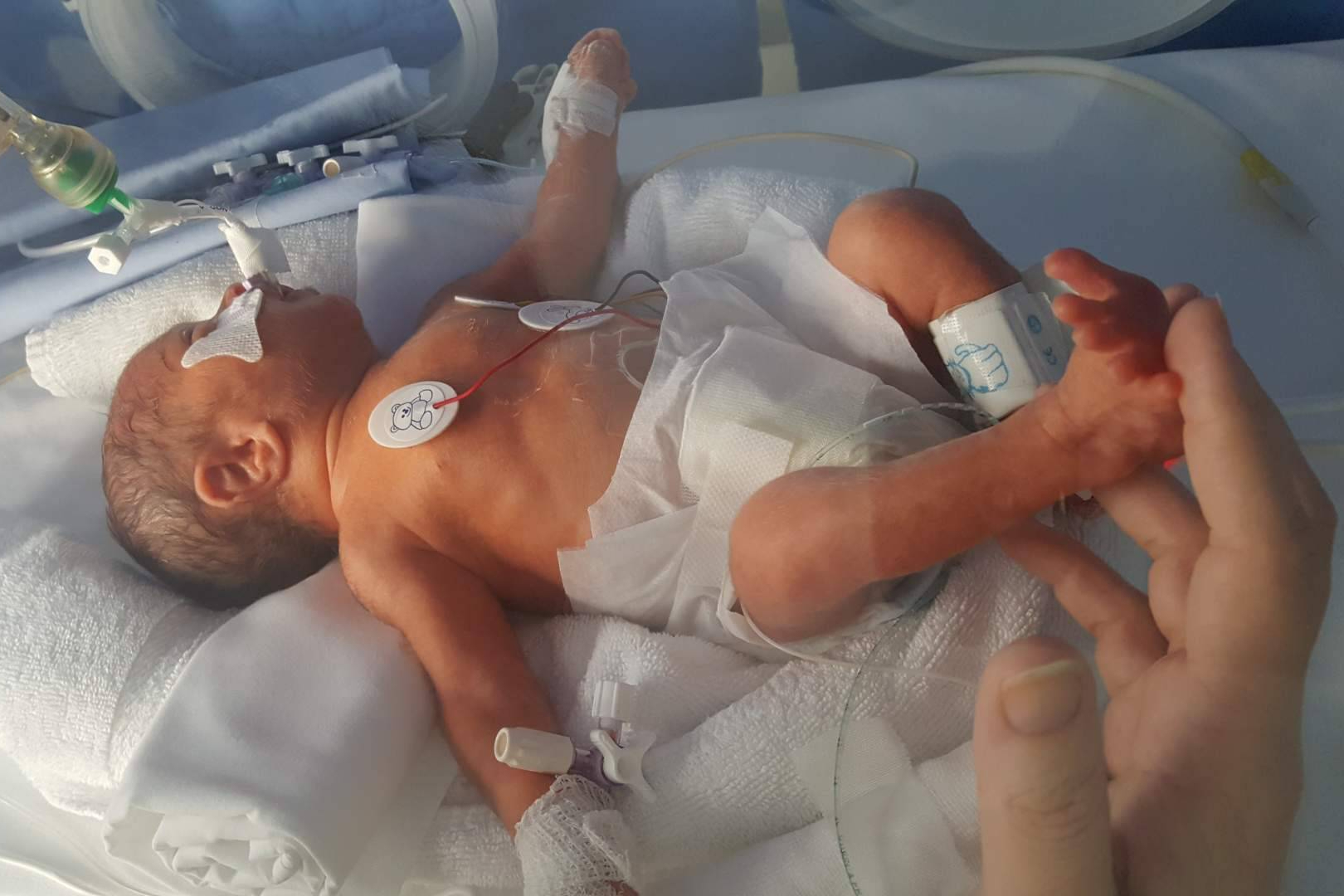 Día Mundial de la Prematuridad; detrás de cada bebé hay una familia que no se rinde