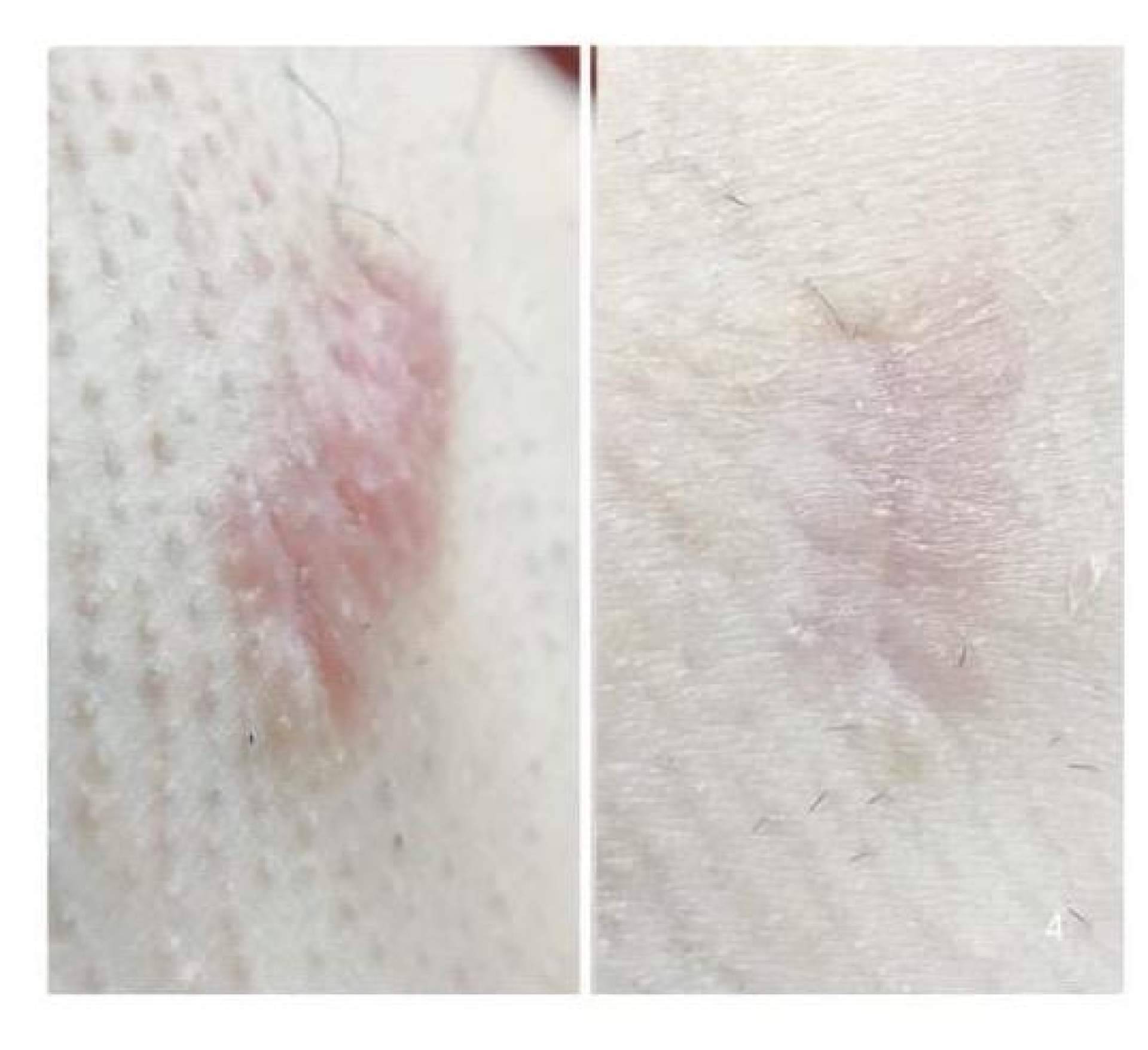 Cicatrices en Barcelona, soluciones avanzadas para marcas cutáneas en Cossbelt by Oksana